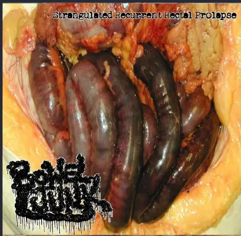 Strangulated Recurrent Rectal Prolapse
